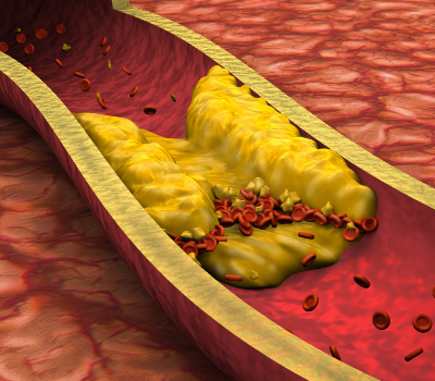 atherosclerosis in Coronary arteries