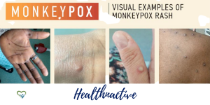 rashes on monkeypox