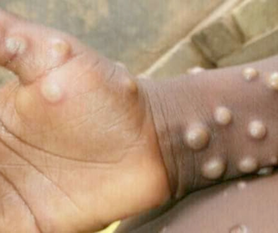Skin lesions on monkeypox